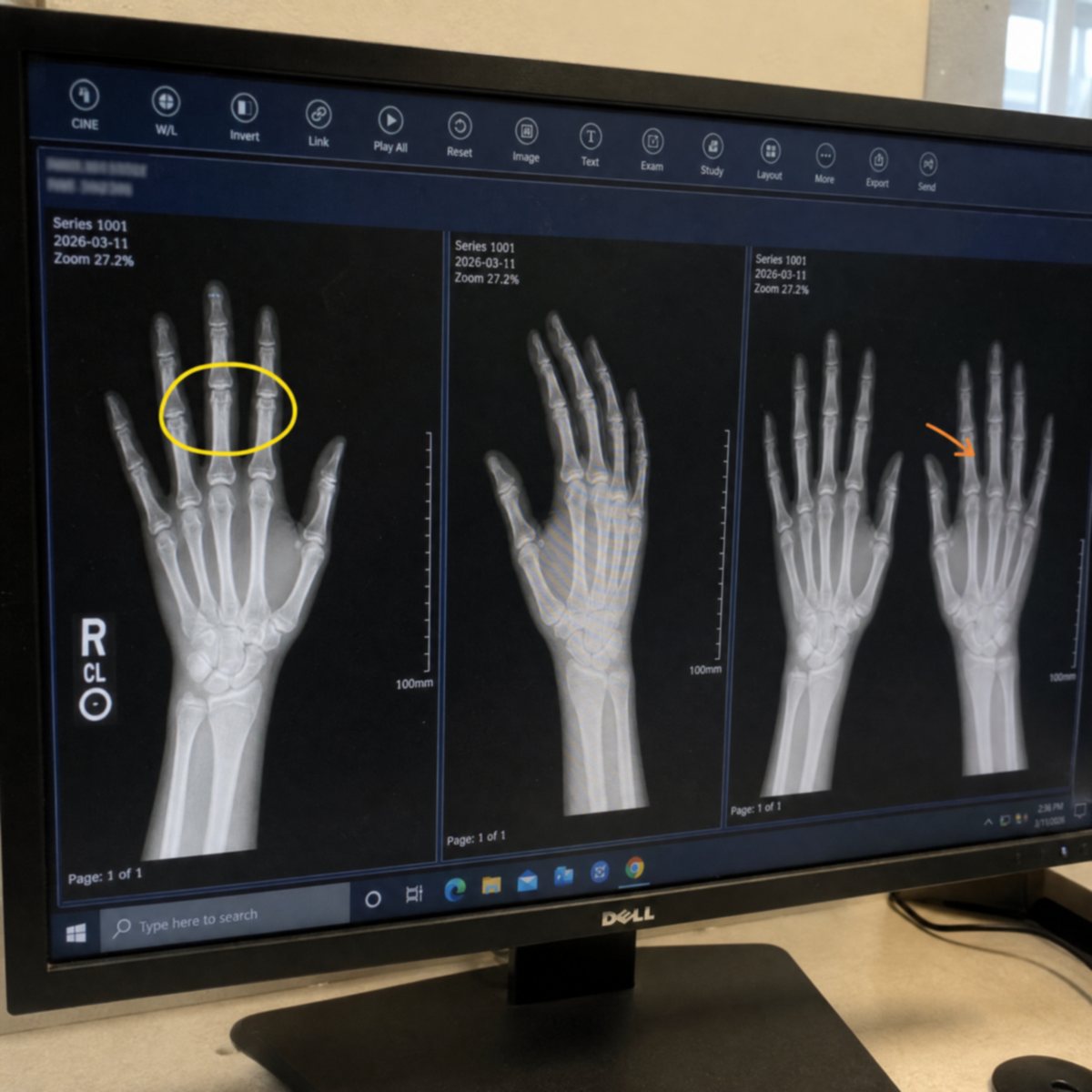 Hand X-ray on a doctor's screen with the finger joints circled